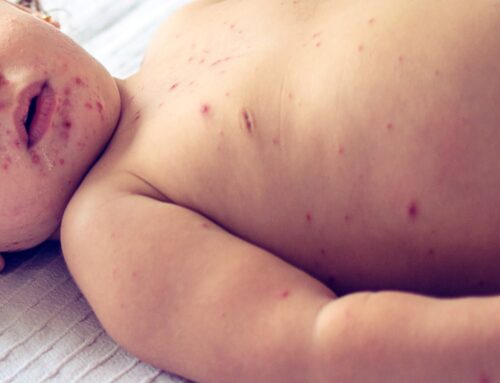 Dr Kash Korner:  Measles in Kids: Symptoms & Prevention